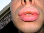 Exfoliative cheilitis after 12 years ... (Click to enlarge)