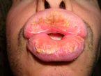 Exfoliative cheilitis after 12 years 3  ... (Click to enlarge)