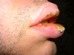 Exfoliative cheilitis after 12 years 9 3 ... (Click to enlarge)