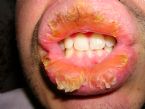 Exfoliative cheilitis after 12 years 9 4 ... (Click to enlarge)