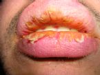 Exfoliative cheilitis after 12 years 9 5 ... (Click to enlarge)