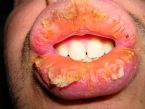 Exfoliative cheilitis after 12 years 9 6 ... (Click to enlarge)