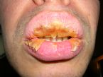 Exfoliative cheilitis after 12 years 9 9 1 ... (Click to enlarge)