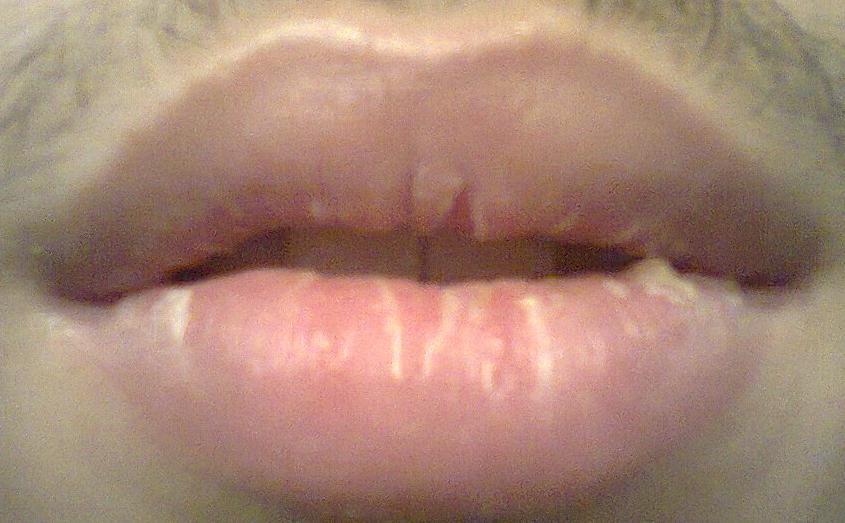 //www.curezone.org/upload/_O_P_Forums/Peeling_Lips/after.jpg