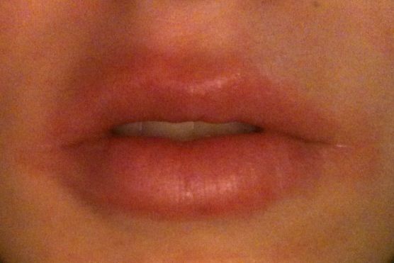 //www.curezone.org/upload/_O_P_Forums/Peeling_Lips/lips4.jpg