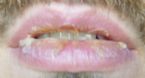 Hyperkeratizination of the lips, Jan 11 ... (Click to enlarge)
