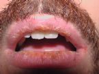 Hyper-keratinization -- December09 (3 years of condition) ... (Click to enlarge)