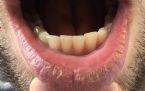 exciimer laser day 1 lower lip