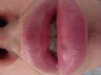 //www.curezone.org/upload/_O_P_Forums/Peeling_Lips/tn-P1020900.jpg