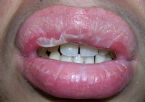 After trying to apply lemon juice mixed with water every evening on lips ... (Click to enlarge)