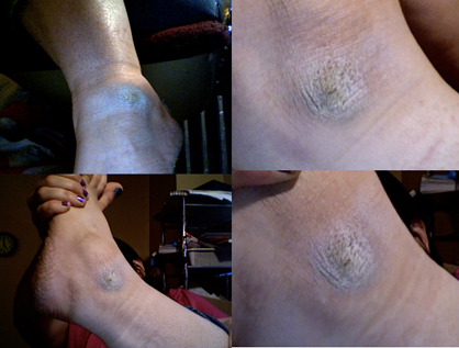 //www.curezone.org/upload/_O_P_Forums/Psoriasis/psorasis.jpg