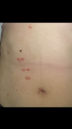 psoriasis on stomach may2017