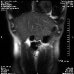 MRI
