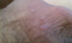 Bumps on testicles. Don't Know What it is. Second Opinion? ... (Click to enlarge)