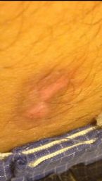 Darkskinspot