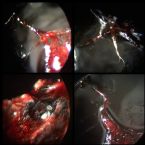 Unknown Skin Parasite Morgellons Larvae or ? ... (Click to enlarge)