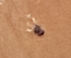 Moving black dot on skin ... (Click to enlarge)