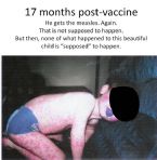 Elijah measles 17 months post mmr