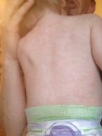 Rebecca R Vaccine induced measles 2