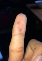 Ae these warts on my finger?