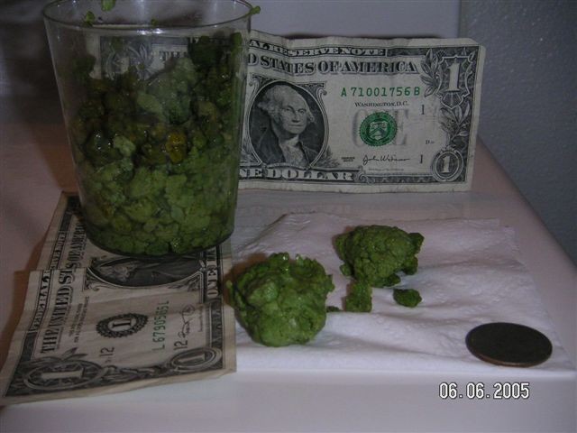 //www.curezone.org/upload/_a_forums/ask_curezone/stones2.JPG