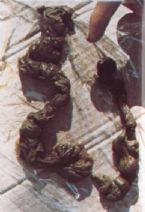 Mucoid Plaque. Photo from Dr. Jensen's  Bowel Management Book ... (Click to enlarge)