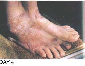 Image: Skin Healing, Psoriasis Gangrene, Dr. Jensen's Bowel Management Book Image: Skin Healing, Psoriasis Gangrene, Dr. Jensen's Bowel Management Book