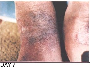 Image: Skin Healing, Psoriasis Gangrene, Dr. Jensen's Bowel Management Book Image: Skin Healing, Psoriasis Gangrene, Dr. Jensen's Bowel Management Book