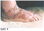Skin Healing, Psoriasis Gangrene, Dr. Jensen's  Bowel Management Book ... (Click to enlarge)