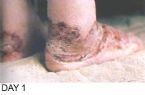 Skin Healing, Psoriasis Gangrene, Dr. Jensen's  Bowel Management Book ... (Click to enlarge)