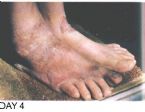 Skin Healing, Psoriasis Gangrene, Dr. Jensen's  Bowel Management Book ... (Click to enlarge)