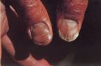 Skin Healing, Psoriasis Gangrene, Dr. Jensen's  Bowel Management Book ... (Click to enlarge)