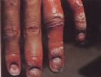 Skin Healing, Psoriasis Gangrene, Dr. Jensen's  Bowel Management Book ... (Click to enlarge)