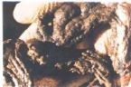 Mucoid Plaque. Photo from Dr. Jensen's  Bowel Management Book ... (Click to enlarge)