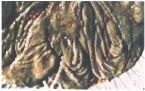 Mucoid Plaque. Photo from Dr. Jensen's  Bowel Management Book ... (Click to enlarge)