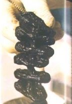 Mucoid Plaque. Photo from Dr. Bernard Jensen's  Bowel Management Book ... (Click to enlarge)