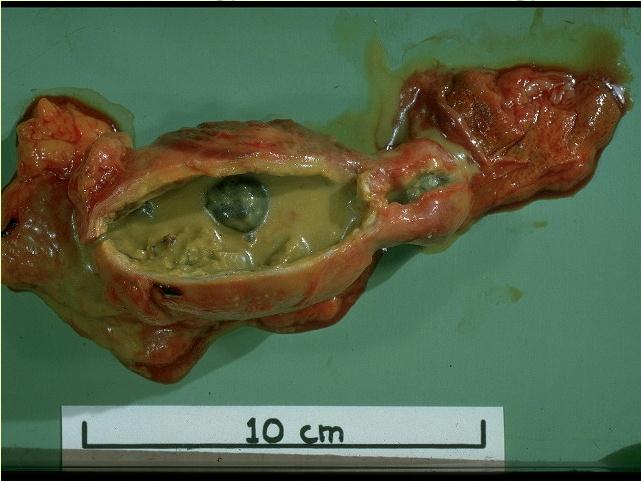 Gallstones from the gallbladder On CureZone Image Gallery