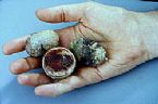 gallstones from the gallbladder ... (Click to enlarge)