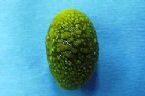 gallstones from the gallbladder ... (Click to enlarge)