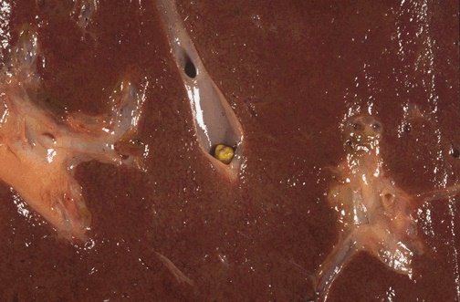 intrahepatic stones intrahepatic stones