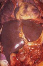 intrahepatic stones ... (Click to enlarge)