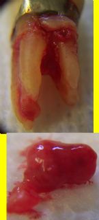 Tooth Abscess ... (Click to enlarge)