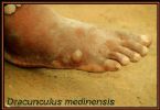 People infected with parasites ... (Click to enlarge)