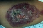 People infected with parasites ... (Click to enlarge)